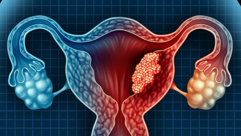 Conheça mais sobre a Endometriose